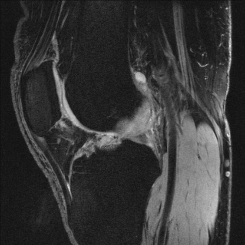 Anterior cruciate ligament mucoid degeneration (Radiopaedia 68400-77933 Sagittal 28).jpg