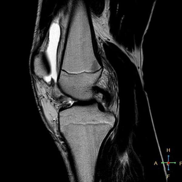 File:Anterior cruciate ligament tear - complete (Radiopaedia 24907-25170 Sagittal T2 11).jpg