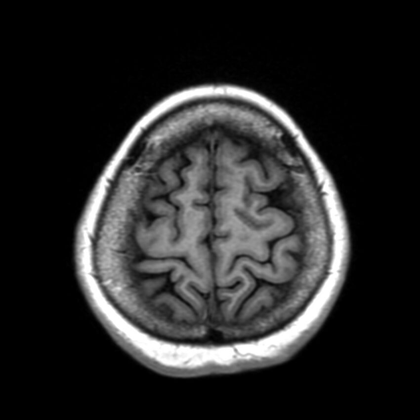 Anti-MOG encephalomyelitis (Radiopaedia 73831-84646 Axial T1 43).jpg