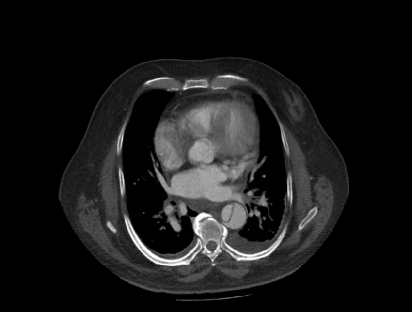 Aortic dissection (Radiopaedia 28802-29105 A 22).jpg