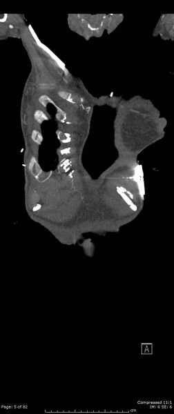 File:Aortic dissection with extension into aortic arch branches (Radiopaedia 64402-73204 A 5).jpg