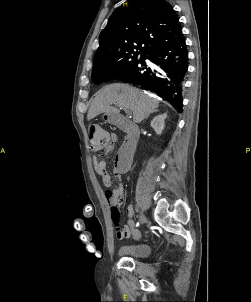 File:Aortoenteric fistula (Radiopaedia 84308-99603 C 129).jpg