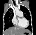 Aortopulmonary window, interrupted aortic arch and large PDA giving the descending aorta (Radiopaedia 35573-37074 D 26).jpg