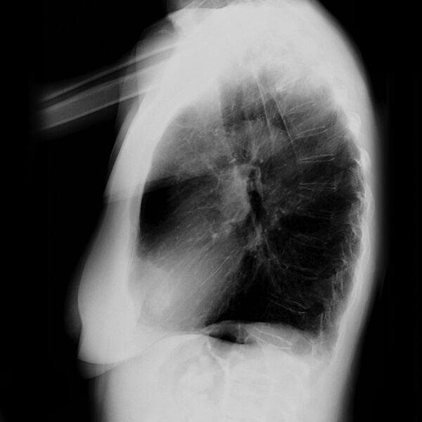 File:Apical non-small-cell lung cancer (Radiopaedia 8570-9404 Lateral 1).jpg