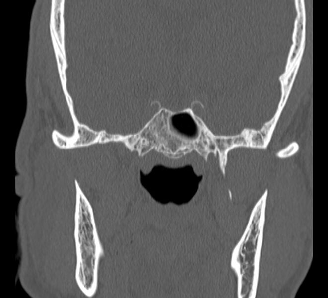File:Aplastic maxillary sinuses (Radiopaedia 60030-67561 Coronal non-contrast 35).jpg