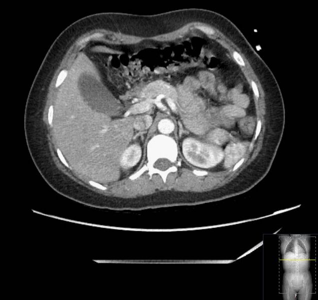 File:Appendicitis (CT angiogram) (Radiopaedia 154713-127660 Axial 147).jpg