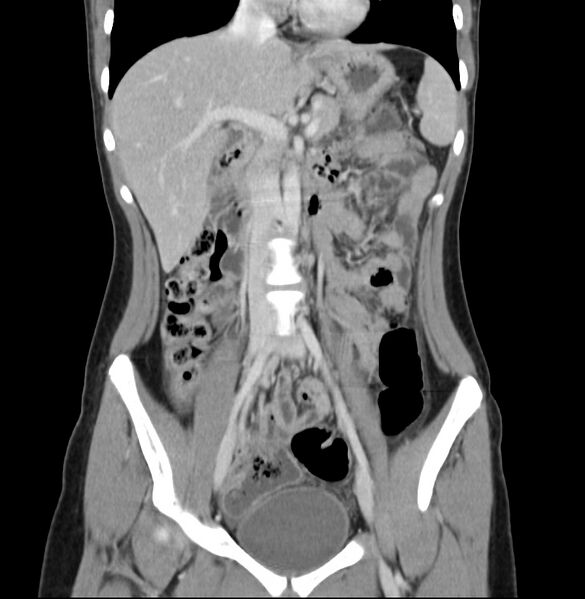 File:Appendicitis and incidental bicornuate uterus (Radiopaedia 22833-22853 D 17).jpg