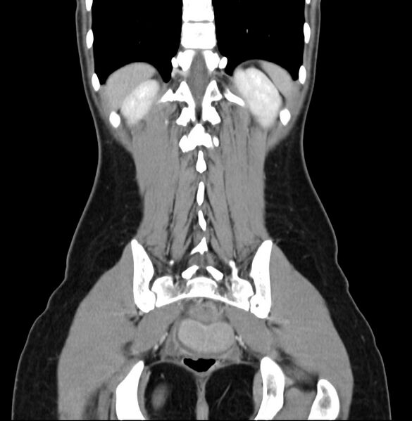 File:Appendicitis and incidental bicornuate uterus (Radiopaedia 22833-22853 D 37).jpg