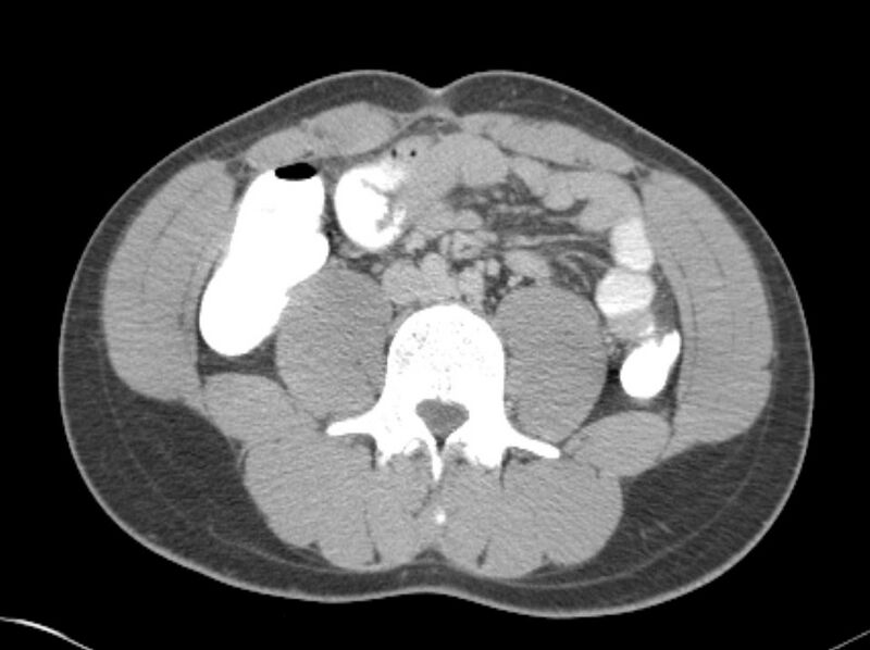File:Appendicitis and incidental foregut duplication cyst (Radiopaedia 52962-58916 A 44).jpg