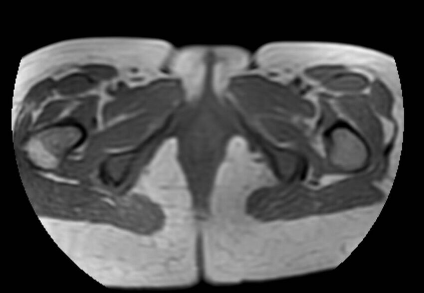 Appendicitis in gravida (MRI) (Radiopaedia 89433-106395 Axial T1 in-phase 74).jpg