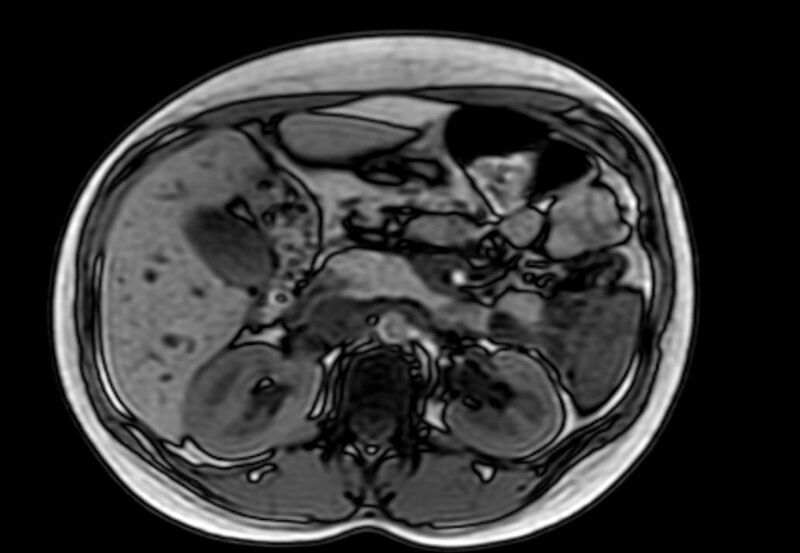 File:Appendicitis in gravida (MRI) (Radiopaedia 89433-106395 D 21).jpg