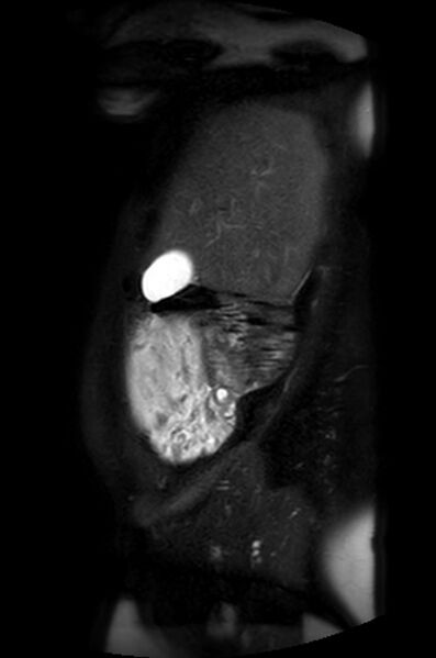File:Appendicitis in gravida (MRI) (Radiopaedia 89433-106395 Sagittal T2 SPAIR 53).jpg