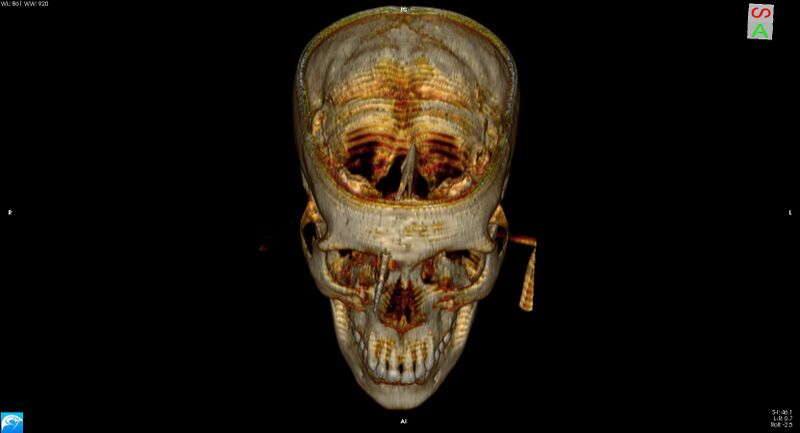 File:Arrow injury to the brain (Radiopaedia 72101-82607 3D bone 12).jpg