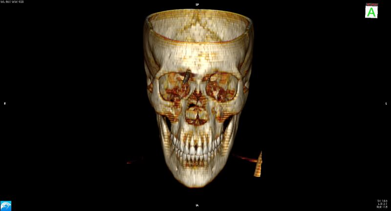 File:Arrow injury to the brain (Radiopaedia 72101-82607 3D bone 5).jpg