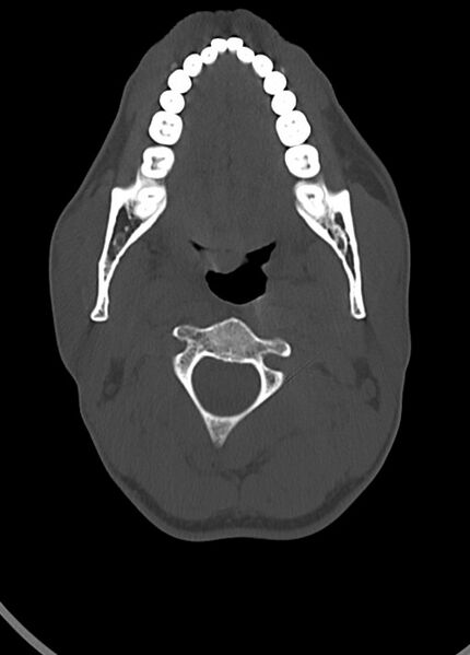 File:Arrow injury to the head (Radiopaedia 75266-86388 Axial bone window 27).jpg