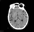 Arteriovenous malformation - cerebral (Radiopaedia 8172-9020 Axial non-contrast 10).jpg