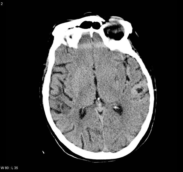 File:Arteriovenous malformation - cerebral (Radiopaedia 8172-9020 Axial non-contrast 10).jpg