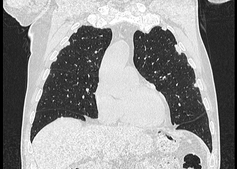 File:Asbestos pleural placques (Radiopaedia 57905-64872 Coronal lung window 90).jpg
