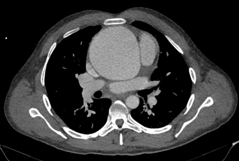 File:Ascending aortic aneurysm (Radiopaedia 86279-102297 C 27).jpg