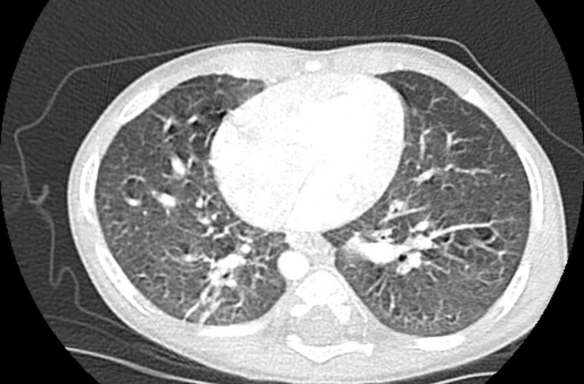 Asplenia syndrome (Radiopaedia 73083-83792 Axial lung window 46).jpg