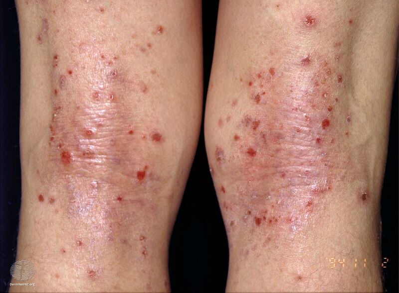 File:Atopic dermatitis (DermNet NZ atopic7).jpg