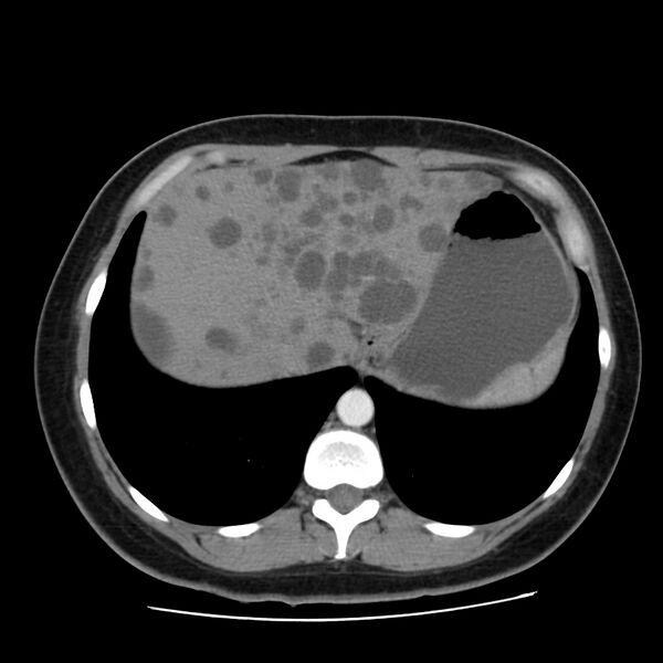 File:Autosomal dominant polycystic kidney disease (Radiopaedia 23061-23093 B 12).jpg