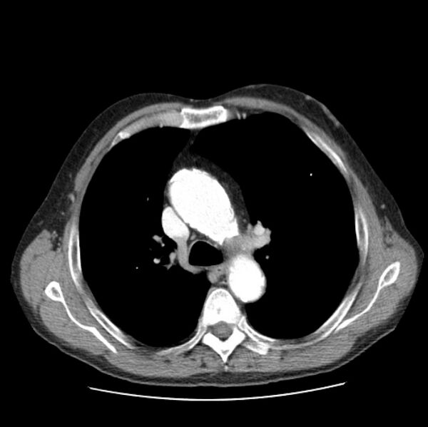 File:Autosomal dominant polycystic kidney disease (Radiopaedia 27851-28094 B 22).jpg