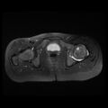 Avascular necrosis of the hip (Radiopaedia 29563-30067 Axial T2 fat sat 10).jpg