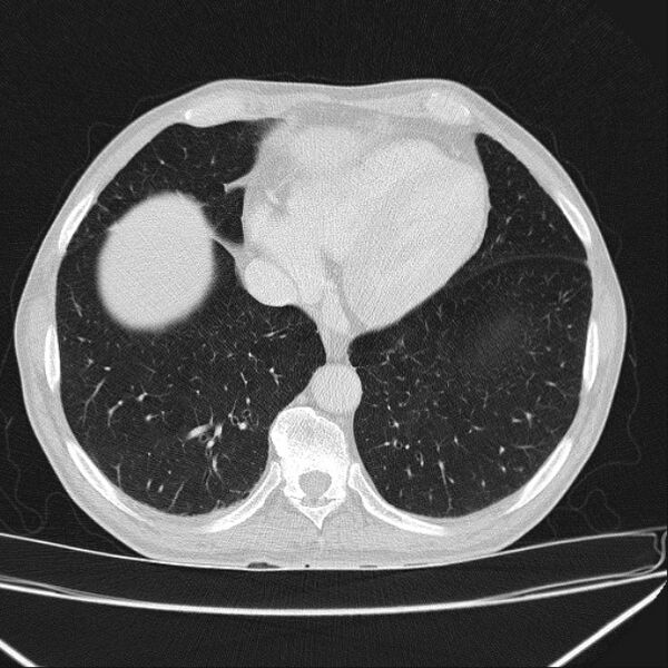 File:Azygos lobe (Radiopaedia 38259-40275 Axial lung window 63).jpg