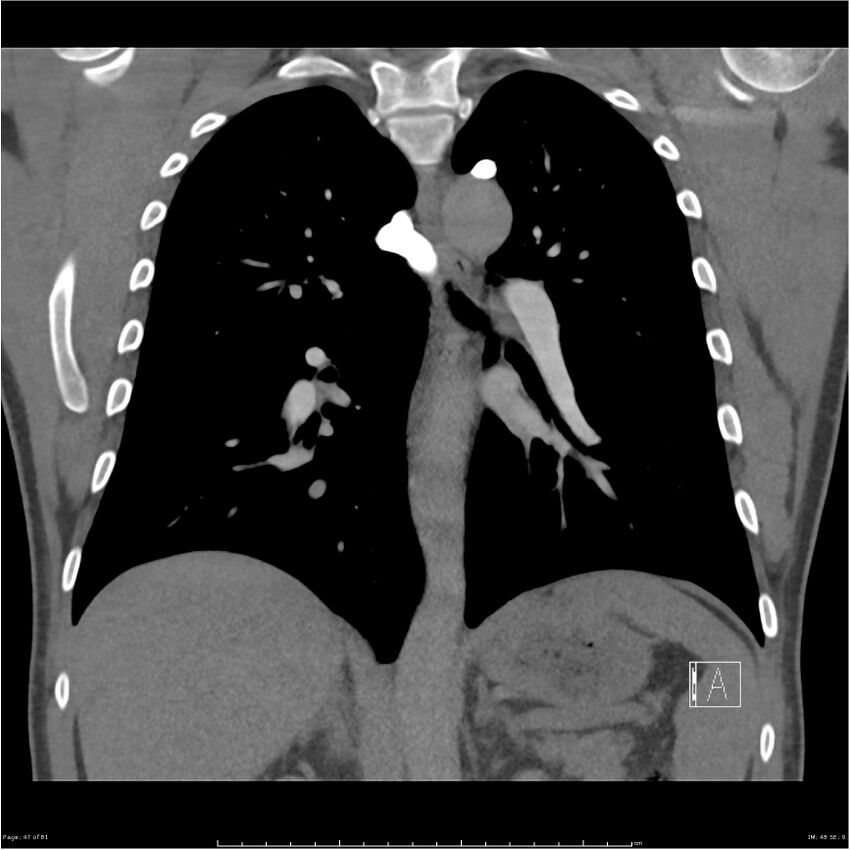 Azygos venous system anatomy (CT pulmonary angiography) (Radiopaedia 25928-26077 Coronal C+ CTPA 47).jpg