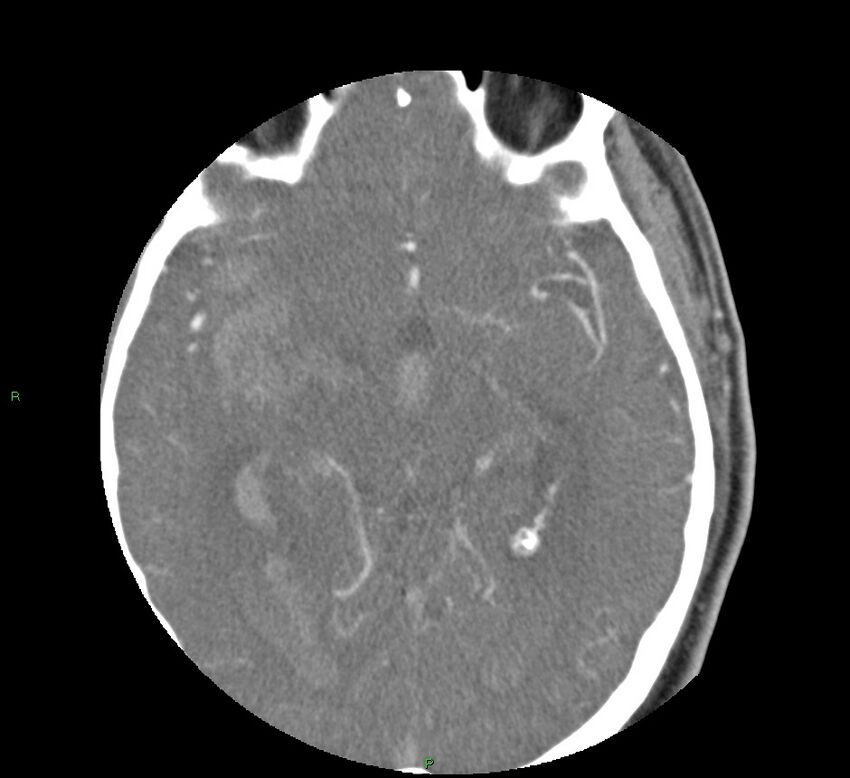 Basal ganglia hemorrhage (Radiopaedia 58763-65985 D 85).jpg
