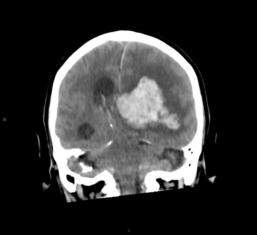 Basal ganglia hemorrhage (Radiopaedia 58775-66008 Coronal non-contrast 28).jpg