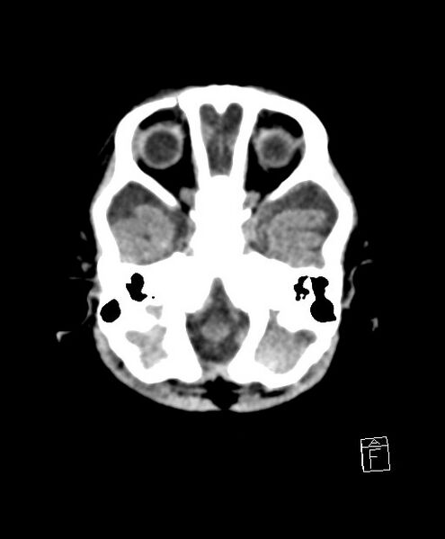 File:Benign enlargement of subarachnoid spaces in infancy (BESS) (Radiopaedia 87459-103795 Axial non-contrast 74).jpg