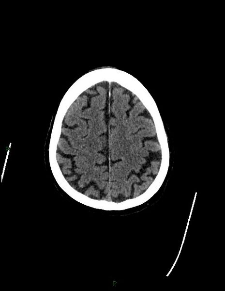 File:Bilateral acute middle cerebral artery territory infarcts (Radiopaedia 77319-89401 Axial non-contrast 71).jpg
