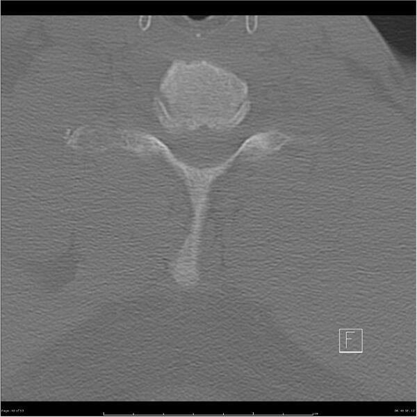 File:Bilateral cervical ribs (Radiopaedia 25868-26017 Axial bone window 40).jpg