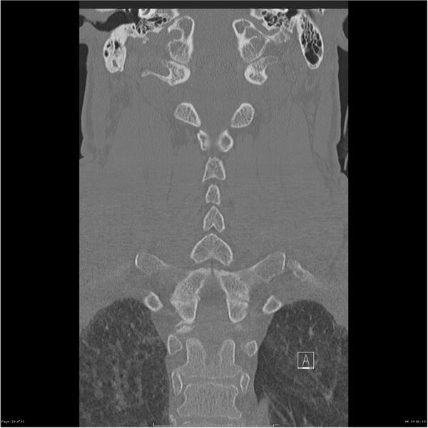 File:Bilateral cervical ribs (Radiopaedia 25868-26017 Coronal bone window 29).jpg