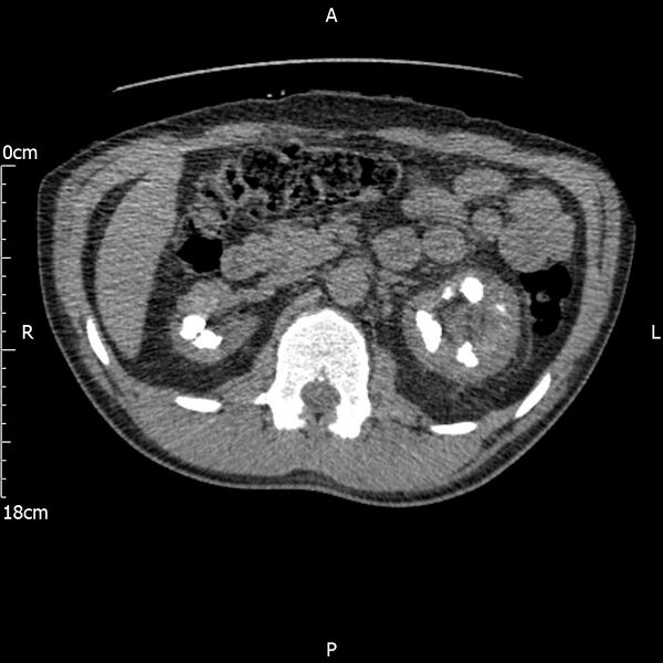 File:Bilateral medullary nephrocalcinosis with ureteric calculi (Radiopaedia 71269-81569 Axial non-contrast 40).jpg