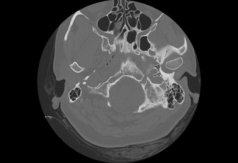 File:Bilateral otospongiosis (Radiopaedia 35447-36940 Axial bone window 5).jpg