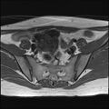 Bilateral ovarian endometriomas (Radiopaedia 87085-103347 Axial T1 5).jpg