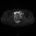 Bilateral ovarian fibroma (Radiopaedia 44568-48293 Axial STIR 17).jpg