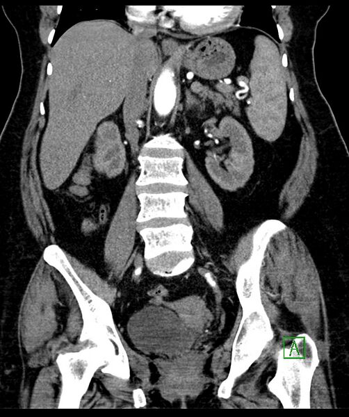 File:Bilateral sporadic synchronous clear cell renal cell carcinoma (Radiopaedia 85035-100575 D 62).jpg