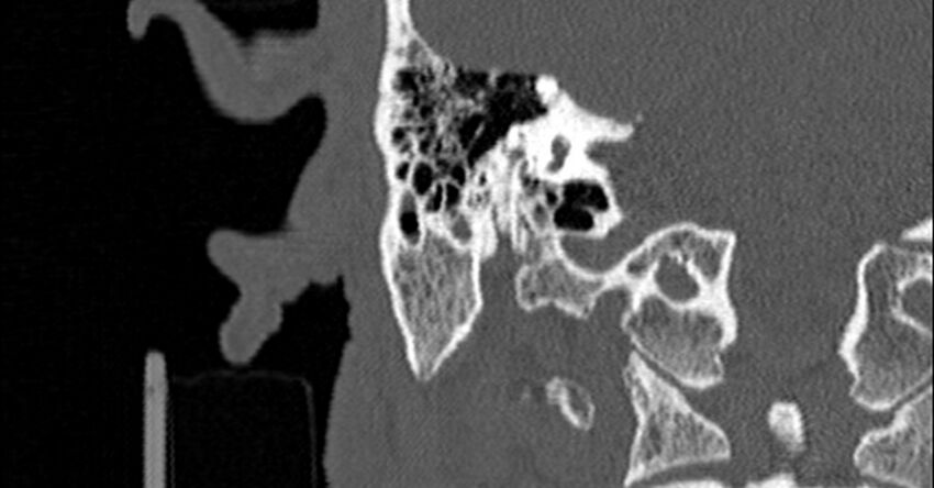Bilateral temporal bone fractures (Radiopaedia 29482-29970 Coronal non-contrast 126).jpg