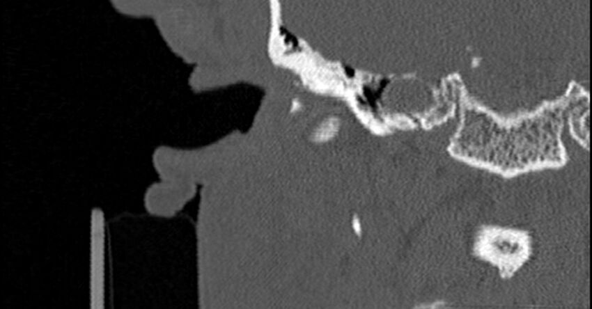 Bilateral temporal bone fractures (Radiopaedia 29482-29970 Coronal non-contrast 75).jpg