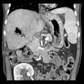 Biliary necrosis - liver transplant (Radiopaedia 21876-21846 C 24).jpg