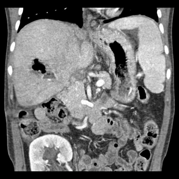 File:Biliary necrosis - liver transplant (Radiopaedia 21876-21846 C 24).jpg