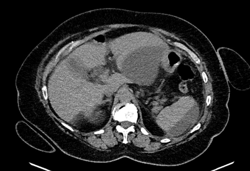File:Biliary pancreatitis (Radiopaedia 72289-82823 Axial non-contrast 83).jpg