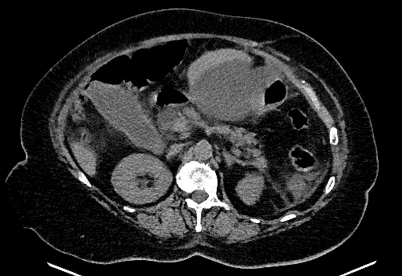 File:Biliary pancreatitis (Radiopaedia 72289-82823 Axial non-contrast 99).jpg