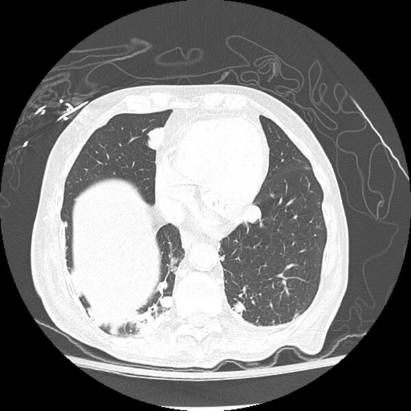File:Bladder cancer metastases (Radiopaedia 9824-10409 Axial lung window 7).jpg