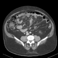 Bladder papillary urothelial carcinoma (Radiopaedia 48119-52951 Axial 33).png