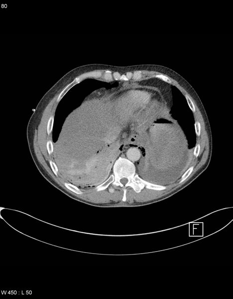 File:Boerhaave syndrome with tension pneumothorax (Radiopaedia 56794-63605 A 39).jpg